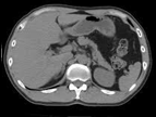 「CT画像 腹部」の画像検索結果