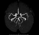 脳MRA（血管）画像
